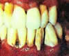Teeth Decay!!
